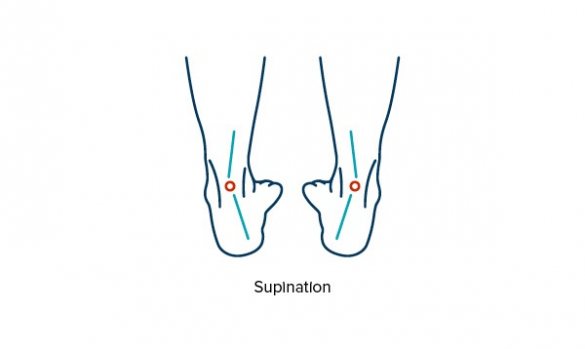 Illustration showing supination and foot misalignment